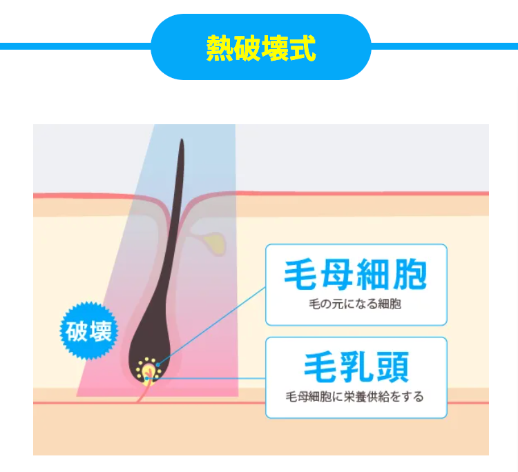 レーザー脱毛の仕組み(メンズリゼHPより)